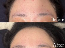 ラティエ(Latier)/美白になりたいならハーブ♪