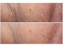 ビオエル(BIOELU)/before　after