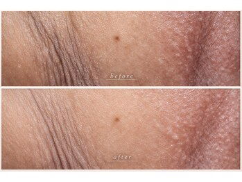 ビオエル(BIOELU)/before after