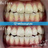 ホワイトニングカフェ 上田店(WhiteningCafe)