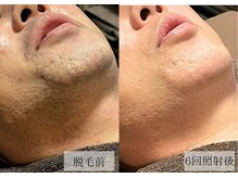 メンズアルファ/【髭】光脱毛before after 40代