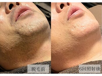 メンズアルファ/【髭】光脱毛before after 40代