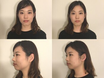 フラット(FURATTO)/Before - After【施術回数1回】