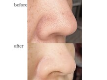 リュミエール デスポワール(Lumiere d'espoir)/毛穴洗浄