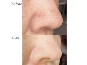 リュミエール デスポワール(Lumiere d'espoir)/毛穴洗浄