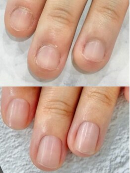 リファーレ(RIFARE)/【深爪矯正】小さい爪から変化!