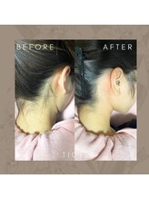 ティグレ 岡山店(TIGRE)/うなじWAX脱毛