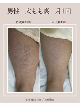 アンジェリカ(Angelica)/メンズひざ上(太もも裏)脱毛