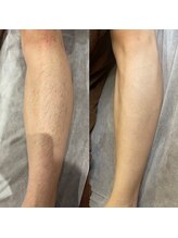 プルメリア(Plumeria)/メンズの足脱毛人気です★