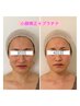 ☆人気急上昇☆小顔頭蓋骨矯正＋プラチナマッサージパック¥8800→¥7700