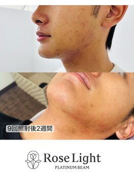 トゥインクル(Twinkle)/脱毛しながらお肌も綺麗に!