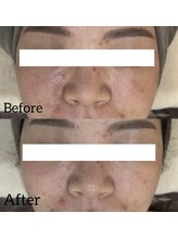 リラ 郡山店(Lilas)/肌を育てるピーリング♪