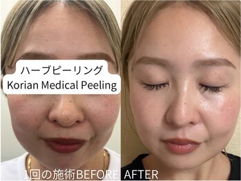 ルーヴレ(LUVRE)の写真/お肌に悩んでる方は是非ご来店下さい！効果絶大の韓国式ピーリング♪