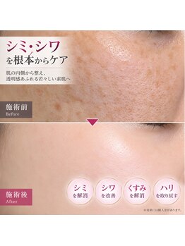 ラー(La)の写真/【看護師施術】何をしても満足できなかった年齢肌へ。シミ・しわ・くすみ・たるみを徹底集中ケア