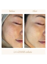 ラジェム(LA GEMME)/美顔フォトで赤みを沈静