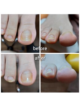 ＵＰジェル／巻いた爪を平に