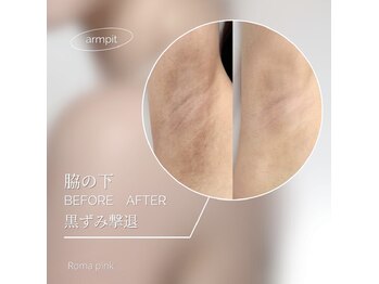 アンヘル(Angel)/ローマピンビフォーアフター