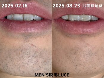 ルーチェ/【ヒゲ脱毛】継続は力なり!