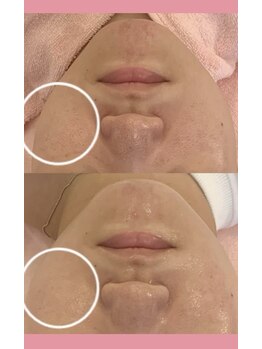 クロエココ(Chloe.cocoo)/お悩みランキング3位/美肌編