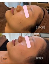 ギルドハナレ(GUILD HANARE)/"プラズマシャワー"