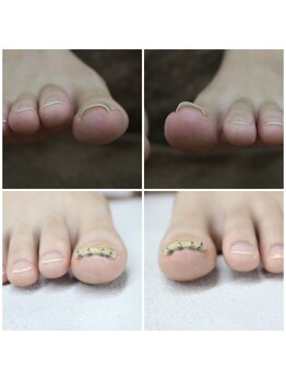【巻き爪矯正】1回目