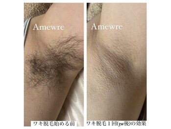アミューレ(Amewre)/脱毛初心者さんは王道のワキ脱毛