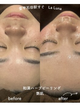 ラルーナ(LA LUNA)/ハーブピーリング