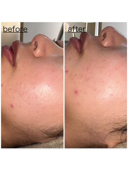 ミニョン(mignon)/毛穴！