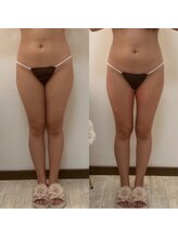 ベル(belle)/【下半身】脂肪冷却