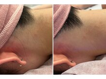 ビューティービレッジ(Beauty village)/うなじギリギリを脱毛照射！