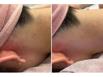 ビューティービレッジ(Beauty village)/うなじギリギリを脱毛照射！