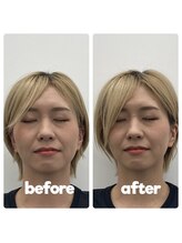 シャルム(CHARMEB)/ガチガチ頭皮も緩める美容鍼