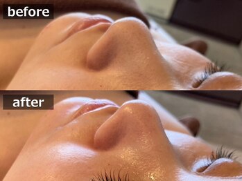 セレブリボーン 大阪ボーテ/ハイドロ毛穴洗浄