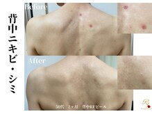 ローズフィールド(Rosefield)/RFピール/背中ニキビ/シミ/毛穴