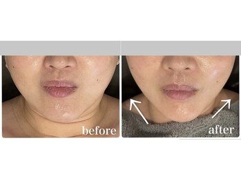 プレローマ(Pleroma)の写真/歪みを整え、たるみ改善でリフトアップ！一度で実感◎表情筋をほぐし理想の小顔へ♪