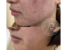 ビーエフジー(B F G)/ハーブピーリングで肌質改善