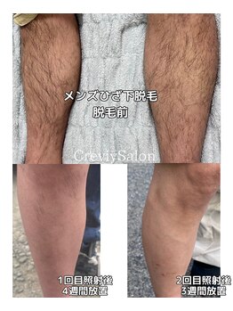 クレヴィー(Creviy)/メンズヒザ下脱毛