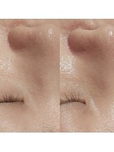 マイフェアレディ 今池(MyFairLady)/毛穴洗浄☆ハイドロフェイシャル