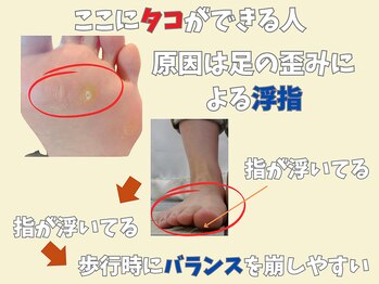 ニコ(niko)/原因は浮指