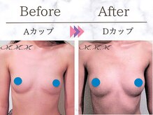 メディカルサロン エム エム エム 銀座プレミアムサロン(M.M.M.)/【バストアップ例】　A→Dカップ