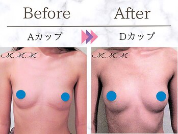 メディカルサロン エム エム エム 銀座プレミアムサロン(M.M.M.)/【バストアップ例】 A→Dカップ