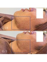 てづか整骨院 美咲が丘院/サロンメンズ】ハーブピーリング