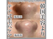 ディンプル(Dimple)の雰囲気（エクストラクションで毛穴の黒ずみ1つ1つにアプローチ）