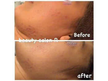 ビューティサロン アール(R)/頑固なお肌トラブルも改善