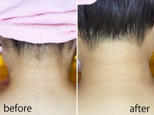 ライトウェーブ 松本村井本店/えり足脱毛　ビフォーアフター