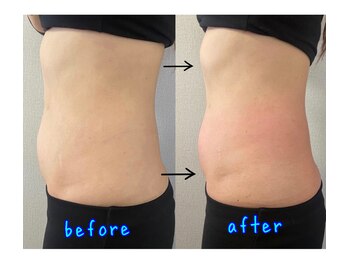 ココフルール(Cocofleur)/デトックスリンパbefore after