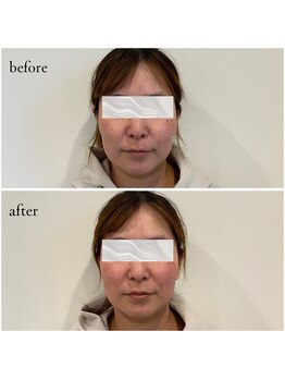 コス(KOS)/美容鍼100本