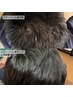 【至高の育毛促進エクソソーム】乳歯歯髄エクソソーム頭皮注入60分