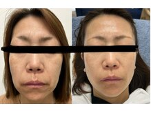 ソラ(SORA)/たるみ改善