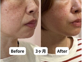 ホープ鍼灸整骨院/10回施術後！